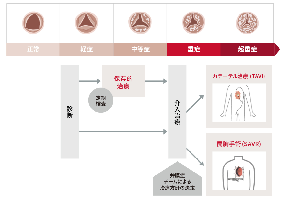 大動脈弁治療検討図.png