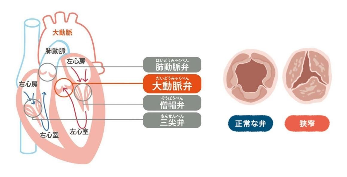 大動脈弁イラスト.jpg