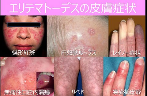 自己免疫性精巣炎はどのように診断されますか?