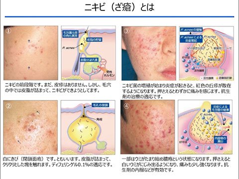 イースト菌感染症 vs おむつかぶれ