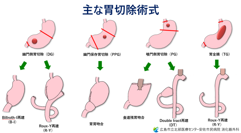 胃がん１.png