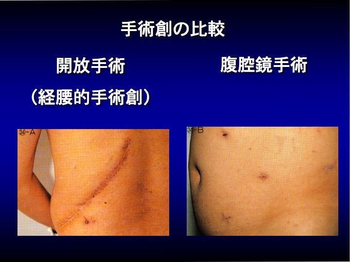 手術創比較.jpg
