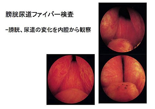 膀胱尿道ファイバー検査