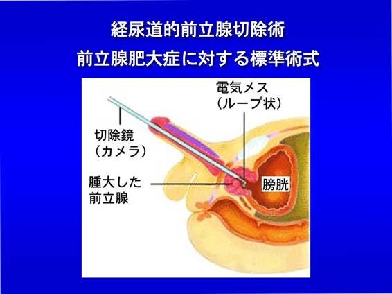 経尿道前立腺切除術