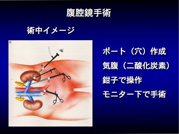 腹腔鏡手術.jpg