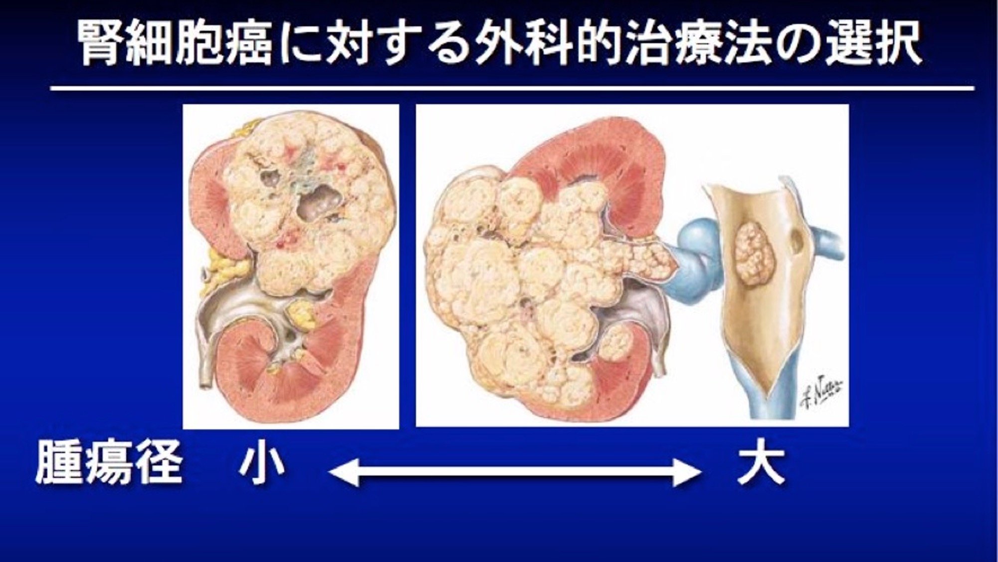 腎癌手術術式選択.jpg